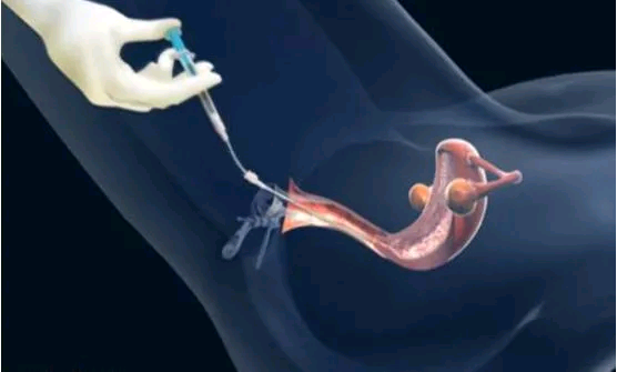 温州36岁供精供卵 温州医科大学附属第二医院的介绍 ‘彩超孕囊看男女1.6×1.